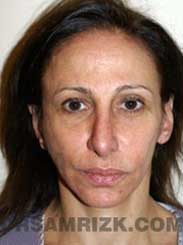 Female patient after Rhinoplasty - img