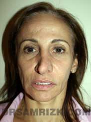 picture Female before Nose Job