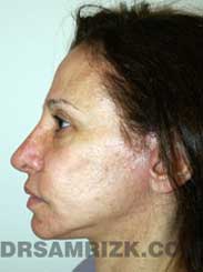 photo female patient after rhinoplasty
