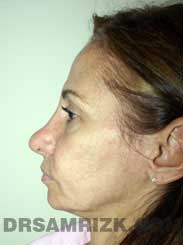 photo female patient before rhinoplasty