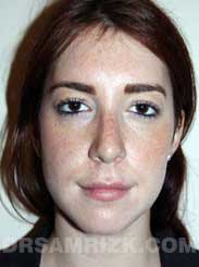 picture female patient after rhinoplasty