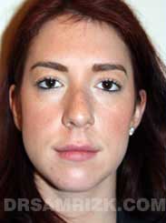 picture female patient before rhinoplasty