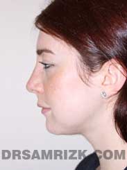 female patient after rhinoplasty