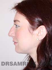 female patient before rhinoplasty