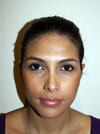Nose Job New York