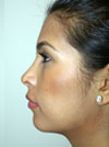 Nose Job New York