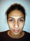 Nose Job New York
