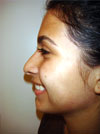 Nose Job New York