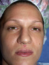 Nose Job New York