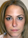 Nose Job New York