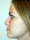 Nose Job New York