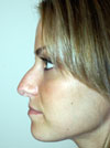 Nose Job New York