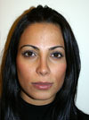 Nose Job New York