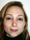 Nose Job New York