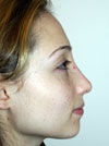 Nose Job New York
