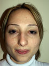 Nose Job New York