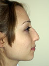 Nose Job New York