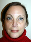 Nose Job NYC