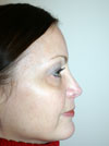 Nose Job NYC