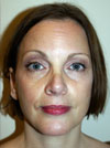 Nose Job NYC