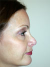 Nose Job NYC