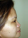 Nose Job NYC