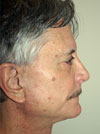 facelift before after picture