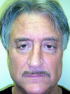 necklift before after picture