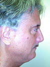 Fnecklift before and after images