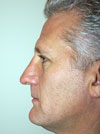 Nose Job New York