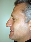 Nose Job New York