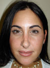 Nose Job NYC