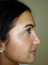 Nose Job NYC