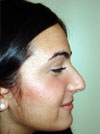 Nose Job NYC