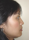 Nose Job NYC