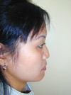 Nose Job NYC
