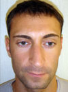Nose Job NYC