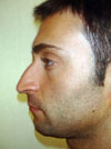 Nose Job NYC
