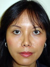 Nose Job NYC