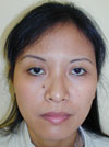 Nose Job NYC