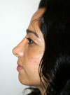 Nose Job NYC