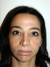 Nose Job NYC