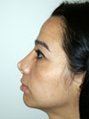 Nose Job NYC