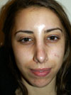 Nose Job NYC