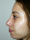 Nose Job NYC