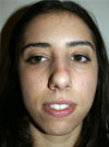 Nose Job NYC
