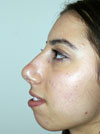 Nose Job NYC