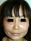 Nose Job NYC
