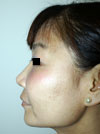 Nose Job NYC
