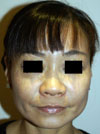 Nose Job NYC